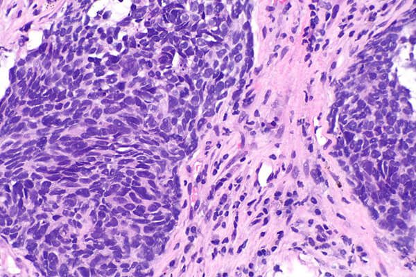 Carcinoma polmonare a grandi cellule, non small cell lung carcinoma