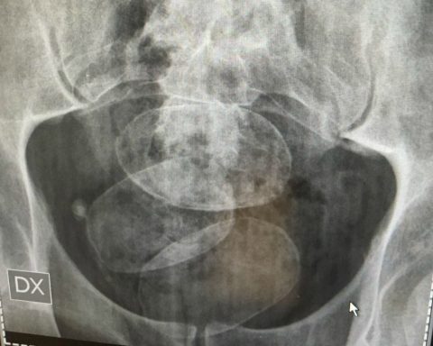 Ovuli di eroina scoperto da un accertamento radiologico (foto di archivio)