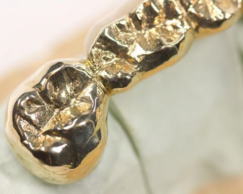 denti-oro