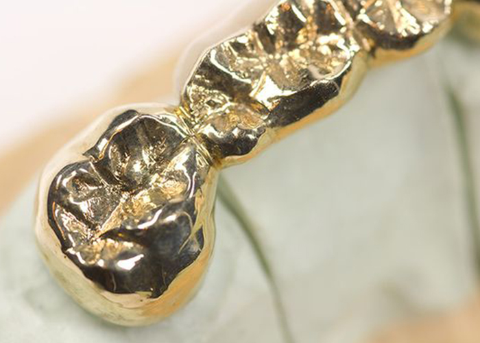 denti-oro