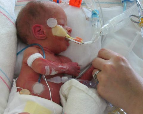 neonato_prematuro