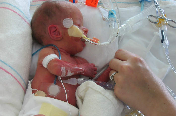 neonato_prematuro